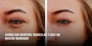 Lee más sobre el artículo Ojeras sin secretos: redúcelas y luce un rostro renovado